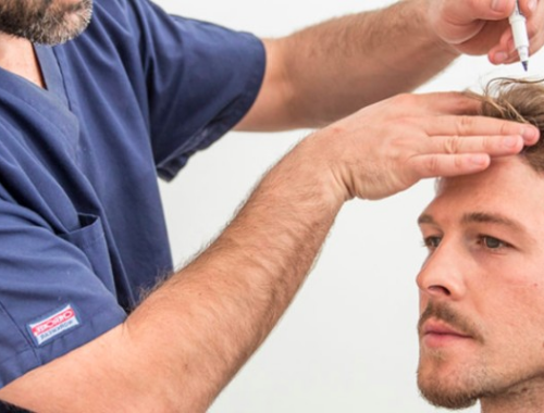 How To Choose a Hair Restoration Method