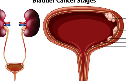 FAQs About Bladder Cancer