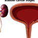 FAQs About Bladder Cancer