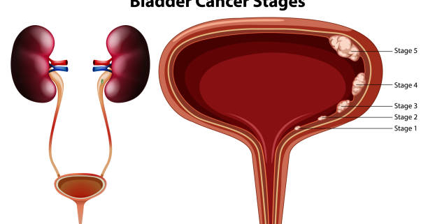 FAQs About Bladder Cancer